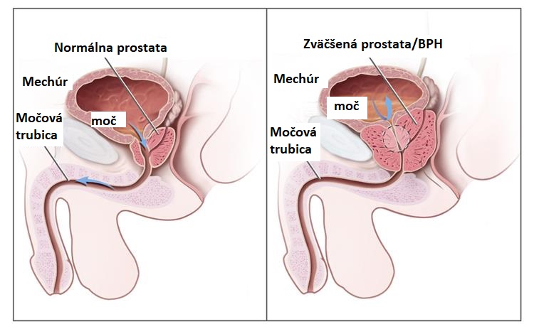 zvětšená prostata